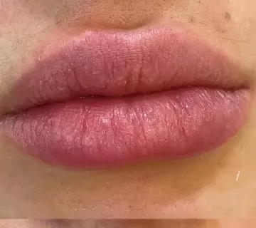 Preenchimento labial e HidraGloss: antes do procedimento