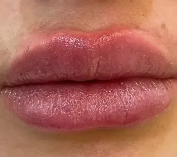 Preenchimento labial e HidraGloss: depois do procedimento