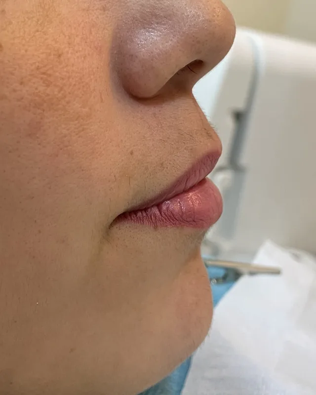 Preenchimento labial, de perfil: antes do procedimento