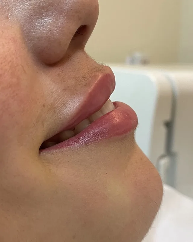 Preenchimento labial, de perfil: depois do procedimento