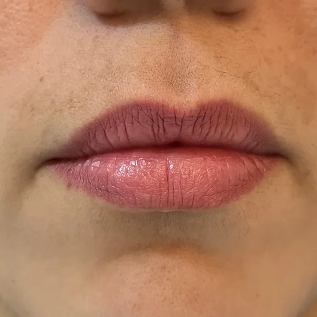 Preenchimento labial, de frente: antes do procedimento