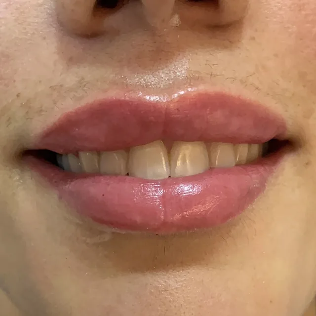 Preenchimento labial, de frente: depois do procedimento