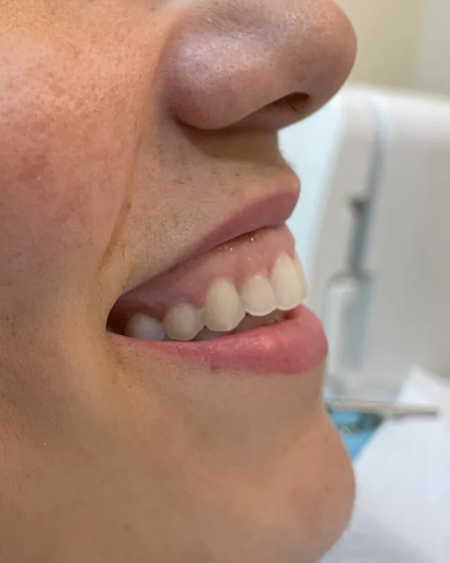 Preenchimento labial, três quartos: antes do procedimento