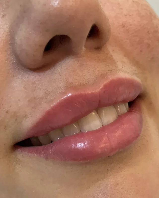 Preenchimento labial, três quartos: depois do procedimento