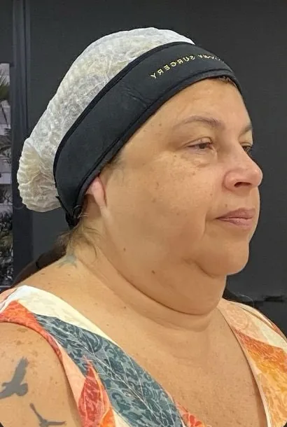 Lipo de papada: antes do procedimento