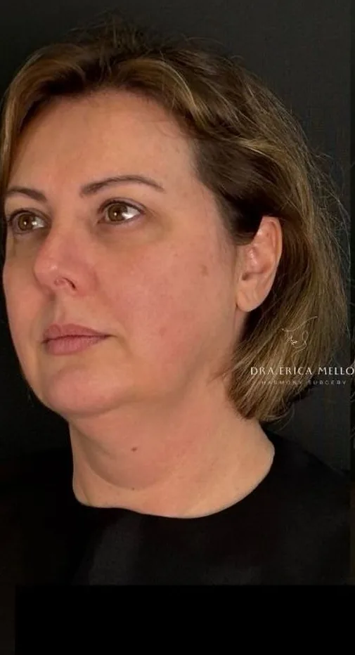 Lipo de papada: antes do procedimento