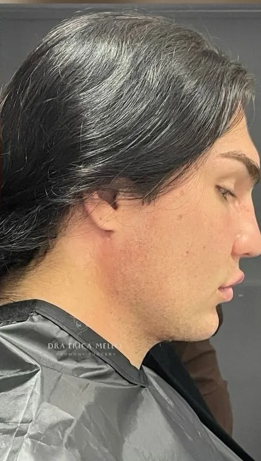Lipo de papada masculina: depois do procedimento