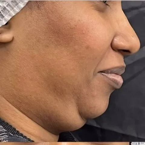 Lipo de papada, de perfil: antes do procedimento