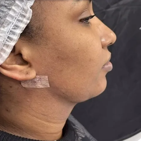 Lipo de papada, de perfil: depois do procedimento