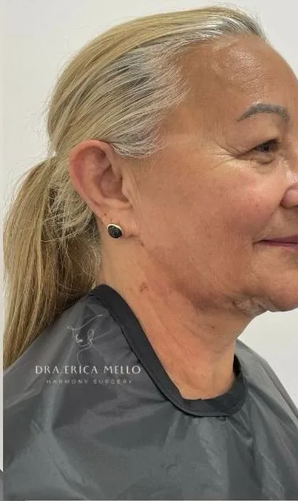 Perfil alinhado: depois do procedimento